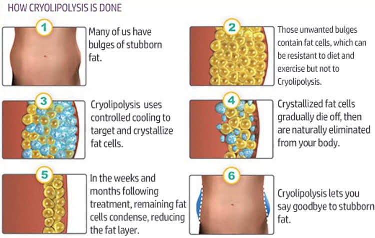 Cryo Lipolysis Diagram